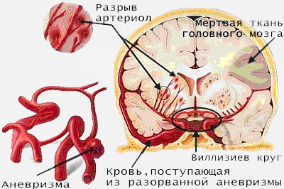 Инсульт