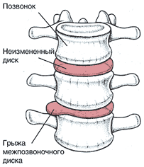 Грыжа диска`