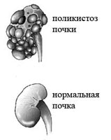 Поликистоз почек