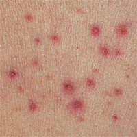 skin-allergy-1.jpg