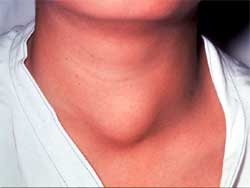 thyroid_tumor.jpg