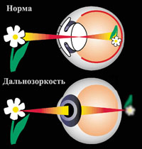 Дальнозоркость 