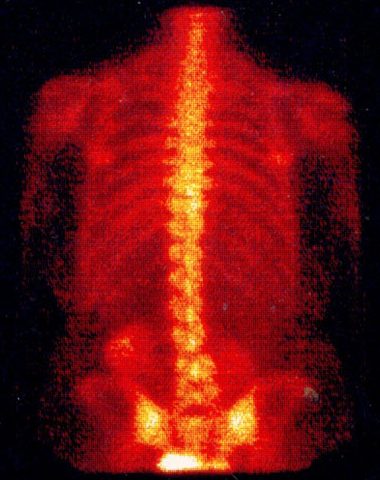 Остеосцинтиграфия