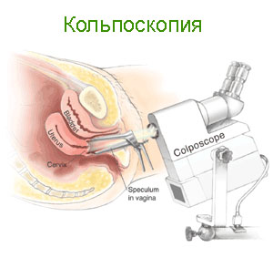 Кольпоскопия