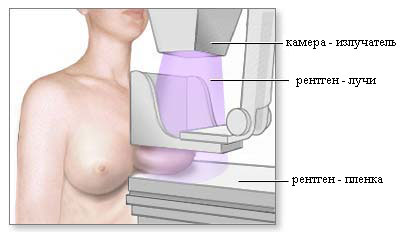 Маммография (Маммограмма)